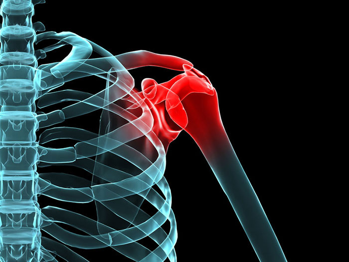Der Frozen Shoulder geht oft eine Gelenk-entzündung voraus, in deren Folge das Schultergelenk verkleben und einsteifen kann.