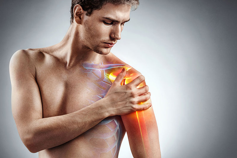 Das Impingementsyndrom der Schulter, eines der häufigsten Ursachen von Schulterschmerzen